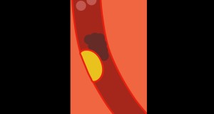 erectile dysfunction cause: cardiovascular disease